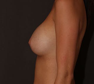 Breast Augmentation Before & After Gallery - Patient 117645832 - Image 10