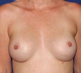 Breast Augmentation Before & After Gallery - Patient 117645859 - Image 2