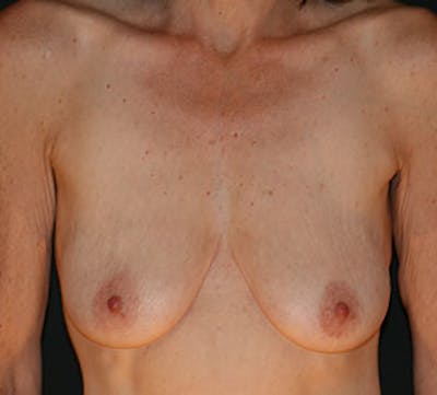 Augmentation-Mastopexy (Implant with Lift) Before & After Gallery - Patient 117645870 - Image 1