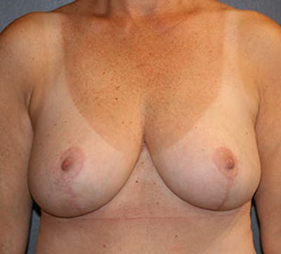 Breast Reduction and Mastopexy (Lift) Before & After Gallery - Patient 117645873 - Image 2