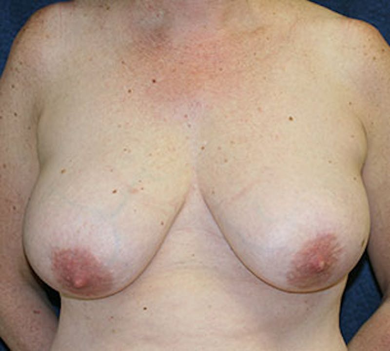 Breast Reduction and Mastopexy (Lift) Before & After Gallery - Patient 117645875 - Image 1