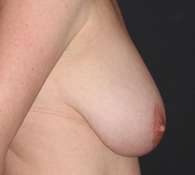 Breast Reduction and Mastopexy (Lift) Before & After Gallery - Patient 117645880 - Image 7