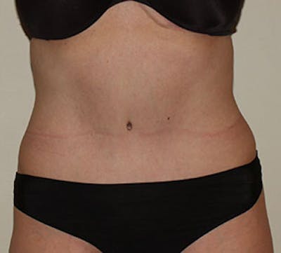 Abdominoplasty (Tummy Tuck) Before & After Gallery - Patient 117645884 - Image 2