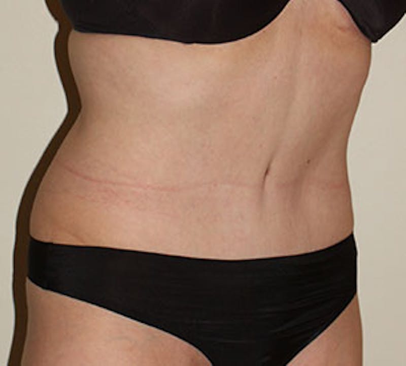 Abdominoplasty (Tummy Tuck) Before & After Gallery - Patient 117645884 - Image 4