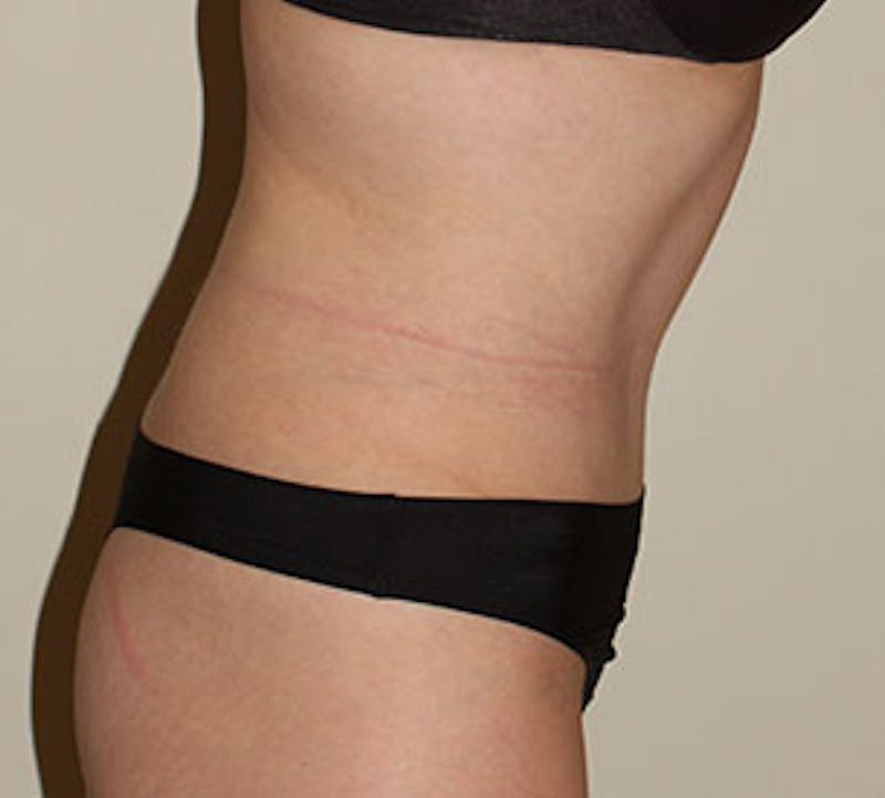 Abdominoplasty (Tummy Tuck) Before & After Gallery - Patient 117645884 - Image 8