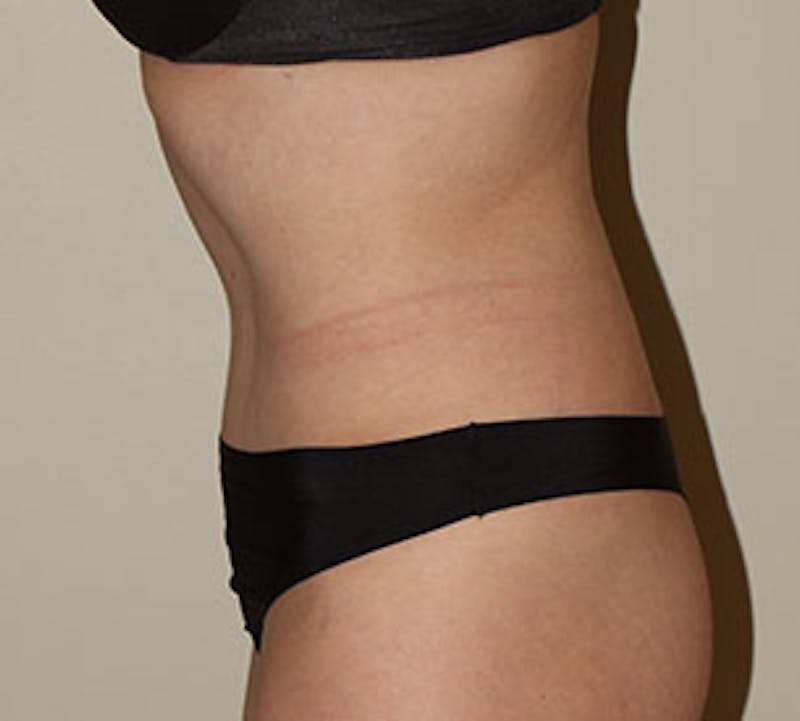 Abdominoplasty (Tummy Tuck) Before & After Gallery - Patient 117645884 - Image 10