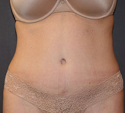 Abdominoplasty (Tummy Tuck) Before & After Gallery - Patient 117645885 - Image 2