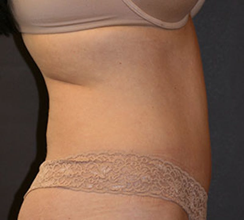Abdominoplasty (Tummy Tuck) Before & After Gallery - Patient 117645885 - Image 6