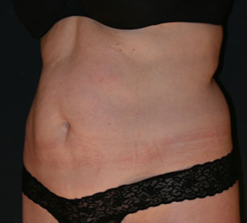 Abdominoplasty (Tummy Tuck) Before & After Gallery - Patient 117645885 - Image 7