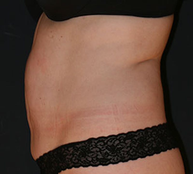 Abdominoplasty (Tummy Tuck) Before & After Gallery - Patient 117645885 - Image 9