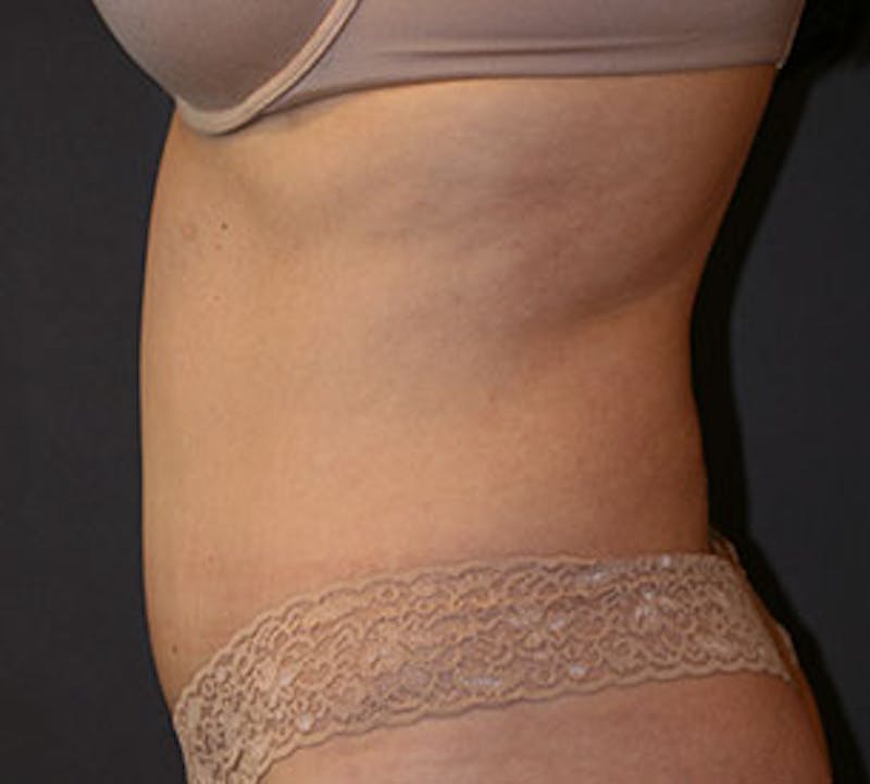Abdominoplasty (Tummy Tuck) Before & After Gallery - Patient 117645885 - Image 10