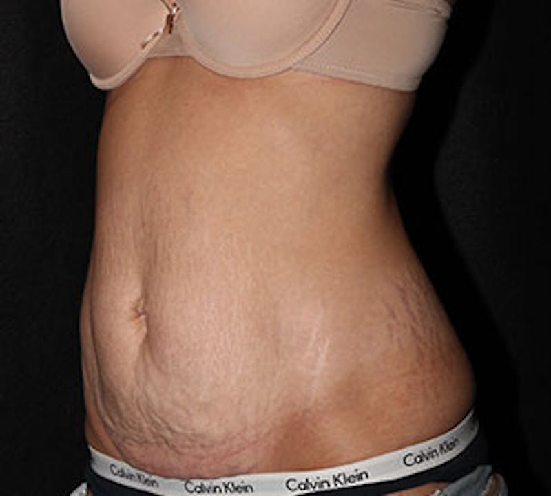 Abdominoplasty (Tummy Tuck) Before & After Gallery - Patient 117645886 - Image 7