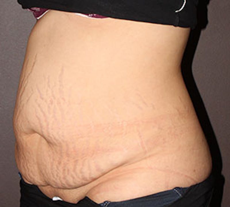 Abdominoplasty (Tummy Tuck) Before & After Gallery - Patient 117645887 - Image 7