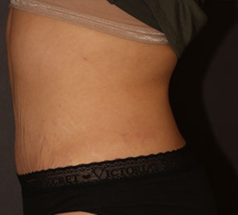 Abdominoplasty (Tummy Tuck) Before & After Gallery - Patient 117645887 - Image 10