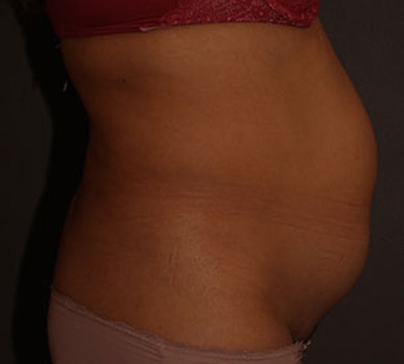 Abdominoplasty (Tummy Tuck) Before & After Gallery - Patient 117645888 - Image 5