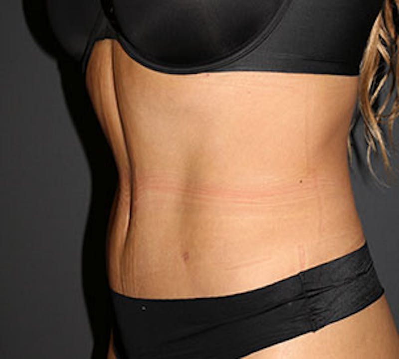 Abdominoplasty (Tummy Tuck) Before & After Gallery - Patient 117645888 - Image 8