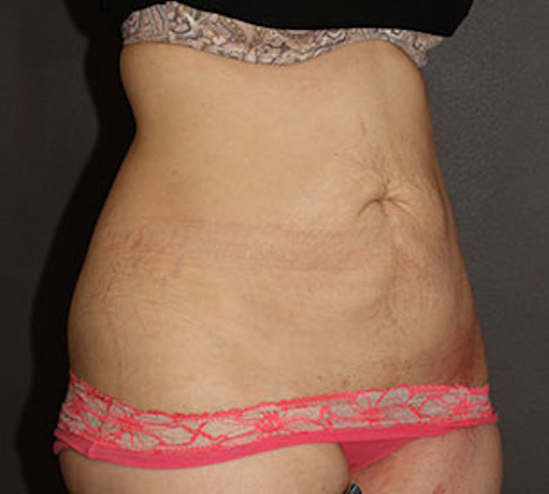 Abdominoplasty (Tummy Tuck) Before & After Gallery - Patient 117645889 - Image 3