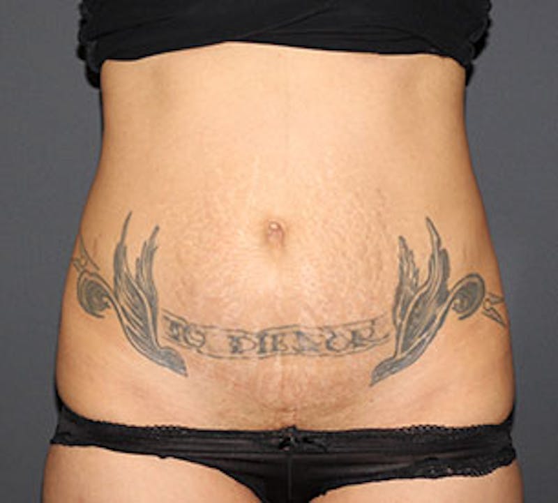 Abdominoplasty (Tummy Tuck) Before & After Gallery - Patient 117645890 - Image 1