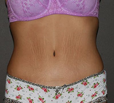 Abdominoplasty (Tummy Tuck) Before & After Gallery - Patient 117645891 - Image 2