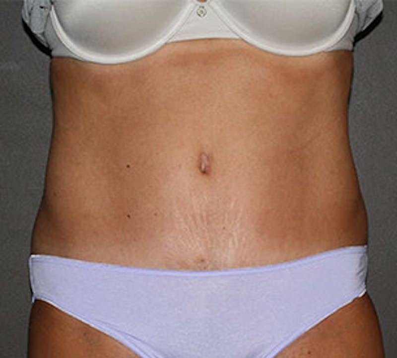 Abdominoplasty (Tummy Tuck) Before & After Gallery - Patient 117645892 - Image 2
