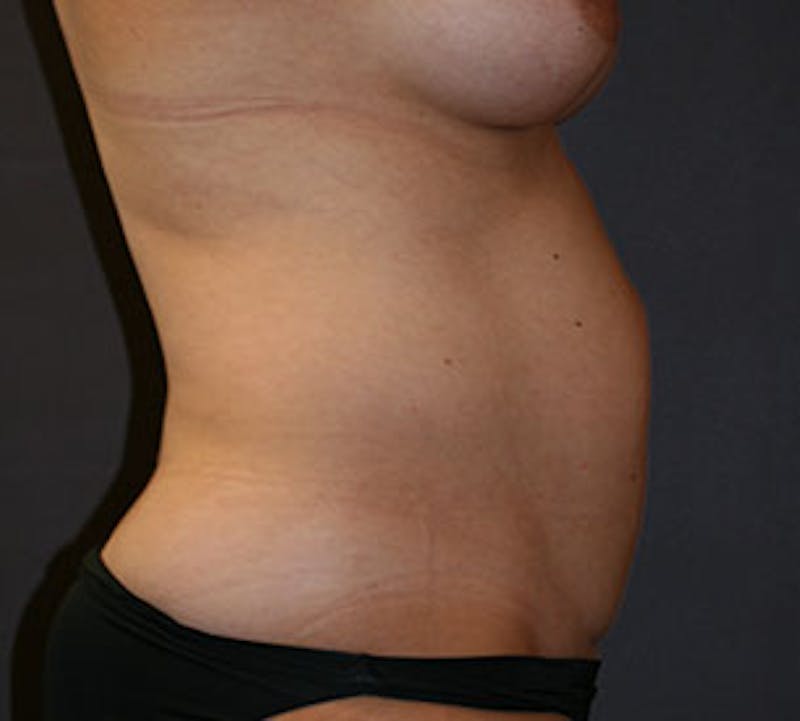 Abdominoplasty (Tummy Tuck) Before & After Gallery - Patient 117645892 - Image 7