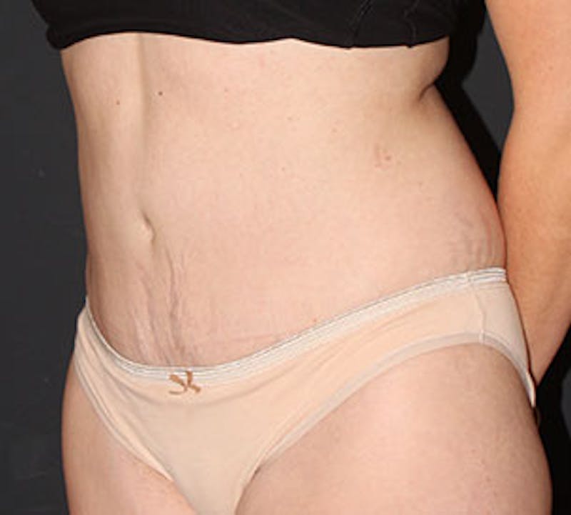 Abdominoplasty (Tummy Tuck) Before & After Gallery - Patient 117645893 - Image 6