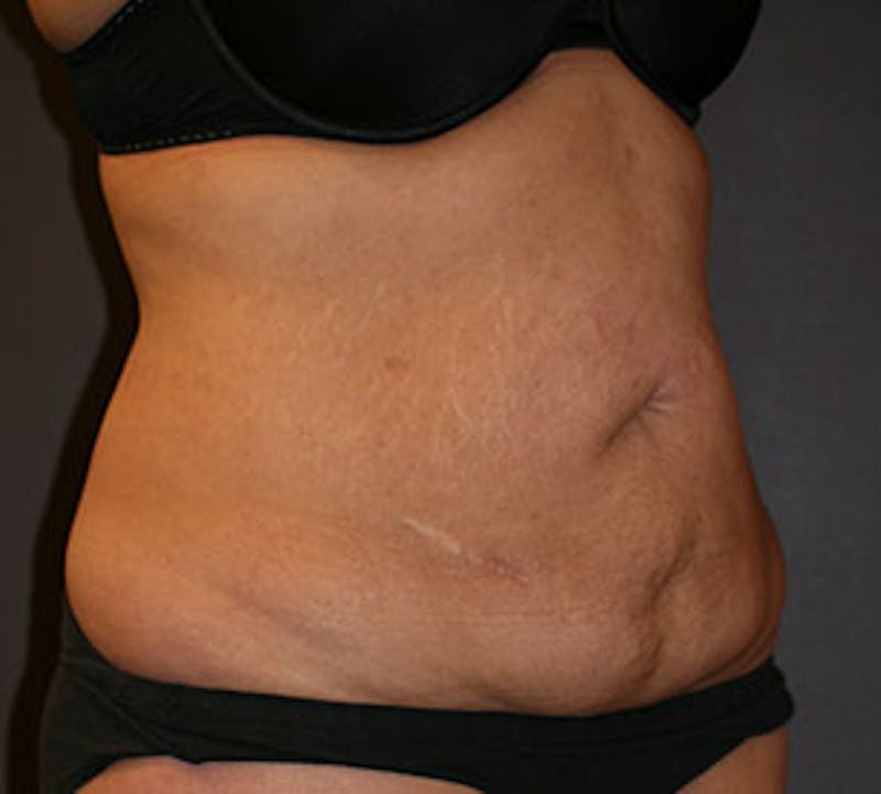 Abdominoplasty (Tummy Tuck) Before & After Gallery - Patient 117645894 - Image 3