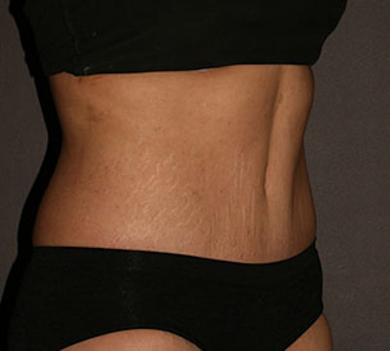 Abdominoplasty (Tummy Tuck) Before & After Gallery - Patient 117645894 - Image 4