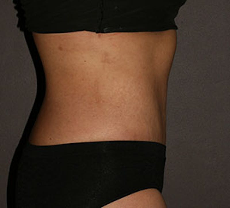 Abdominoplasty (Tummy Tuck) Before & After Gallery - Patient 117645894 - Image 8