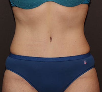 Abdominoplasty (Tummy Tuck) Before & After Gallery - Patient 117645895 - Image 2