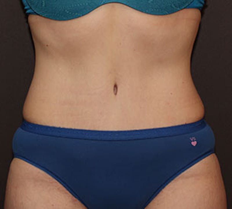 Abdominoplasty (Tummy Tuck) Before & After Gallery - Patient 117645895 - Image 2