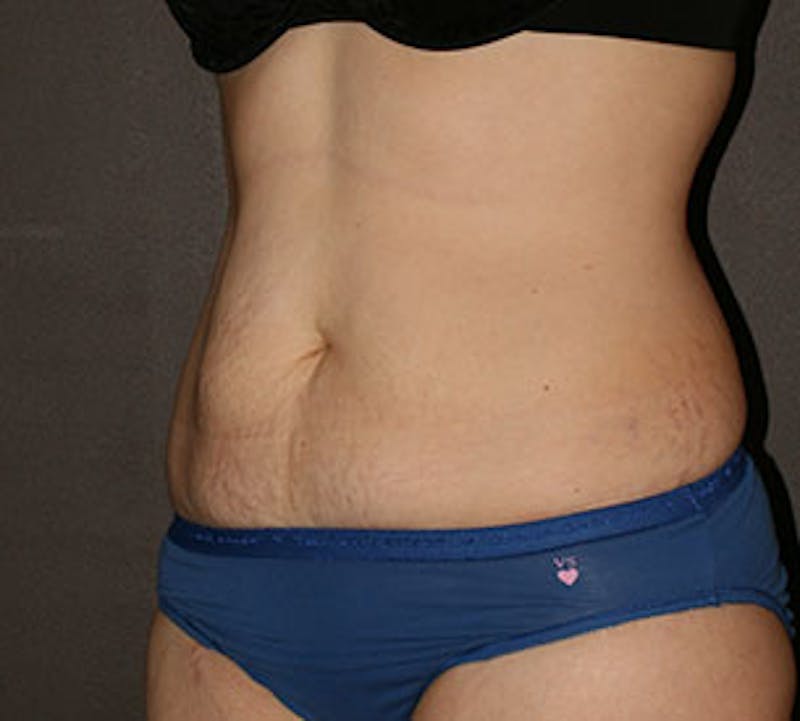 Abdominoplasty (Tummy Tuck) Before & After Gallery - Patient 117645895 - Image 3