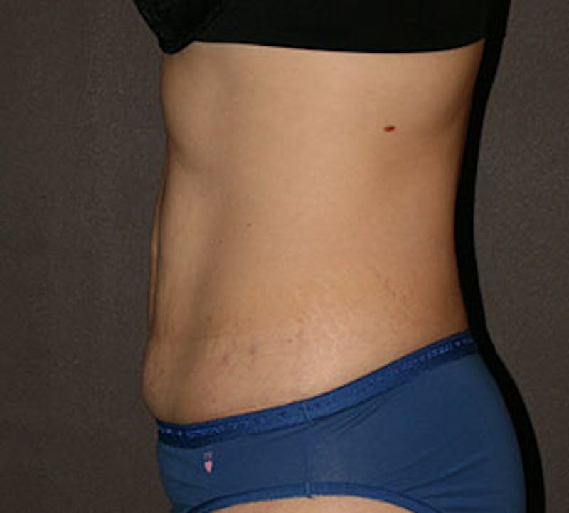 Abdominoplasty (Tummy Tuck) Before & After Gallery - Patient 117645895 - Image 7