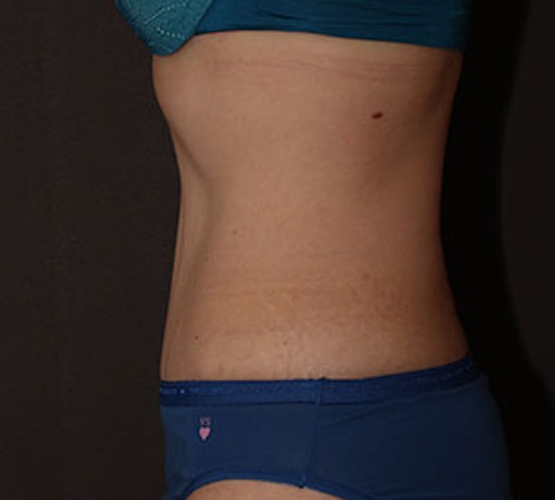 Abdominoplasty (Tummy Tuck) Before & After Gallery - Patient 117645895 - Image 8