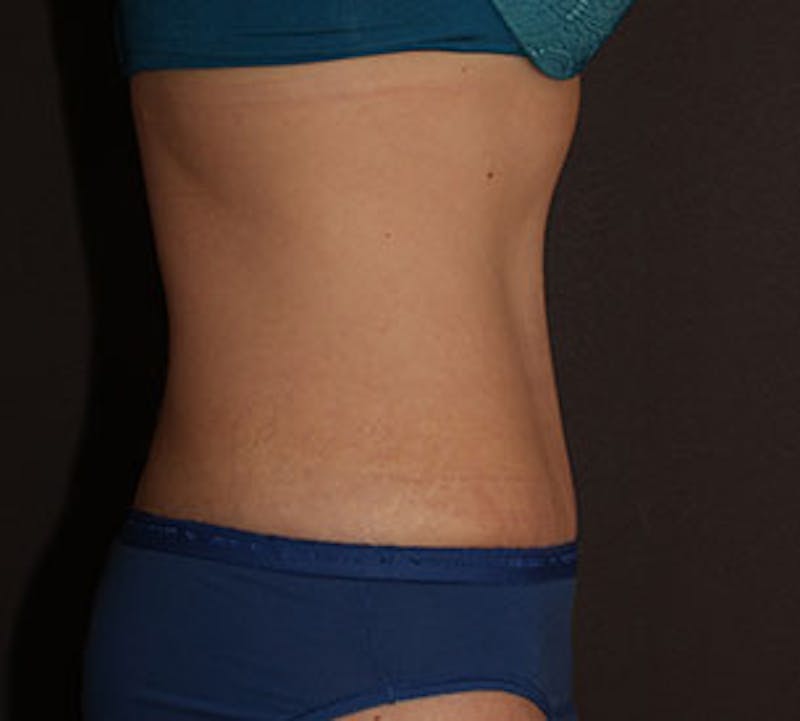 Abdominoplasty (Tummy Tuck) Before & After Gallery - Patient 117645895 - Image 10