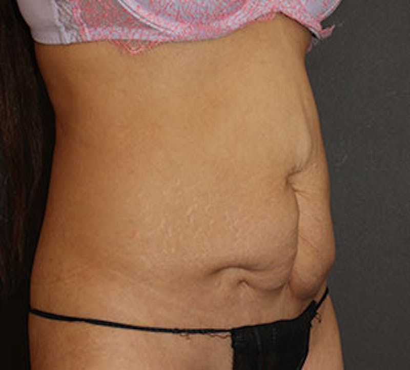 Abdominoplasty (Tummy Tuck) Before & After Gallery - Patient 117645896 - Image 5