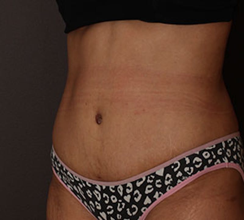 Abdominoplasty (Tummy Tuck) Before & After Gallery - Patient 117645899 - Image 4
