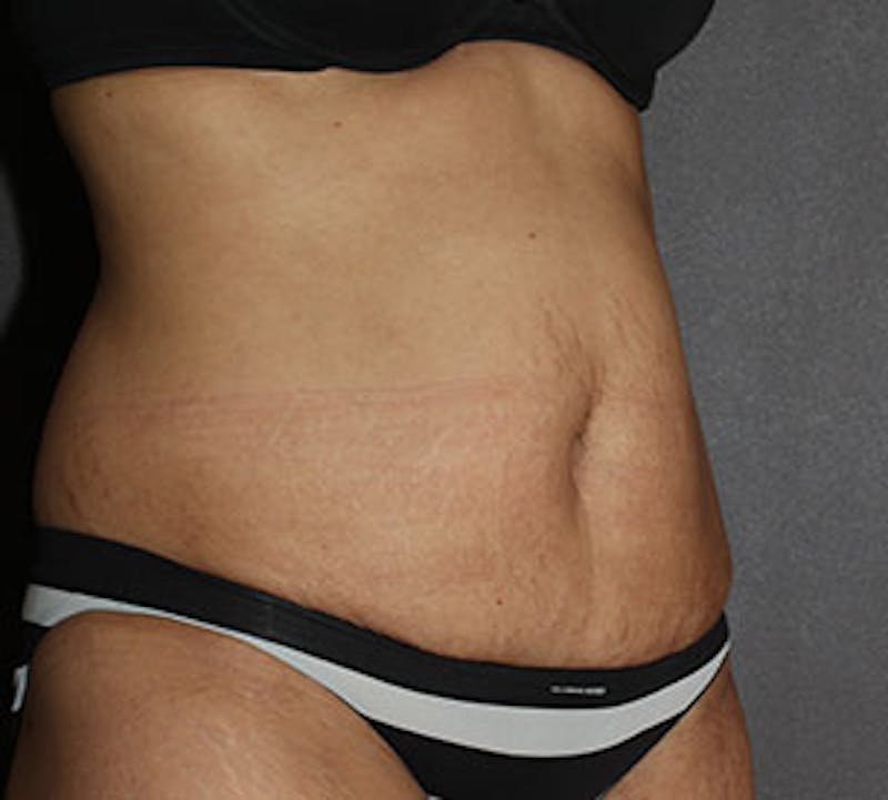 Abdominoplasty (Tummy Tuck) Before & After Gallery - Patient 117645899 - Image 5