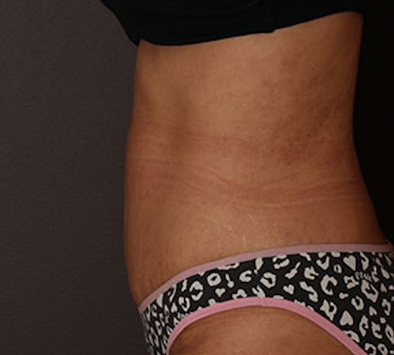 Abdominoplasty (Tummy Tuck) Before & After Gallery - Patient 117645899 - Image 8