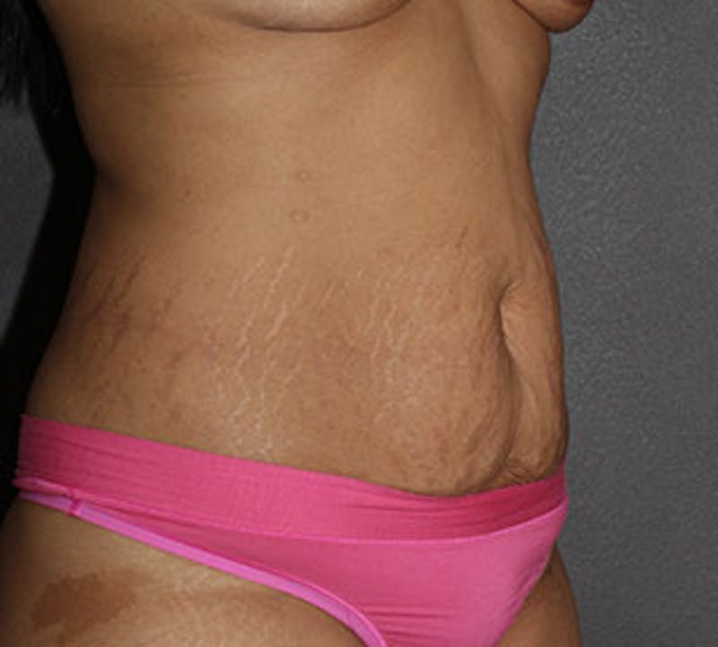 Abdominoplasty (Tummy Tuck) Before & After Gallery - Patient 117645900 - Image 5