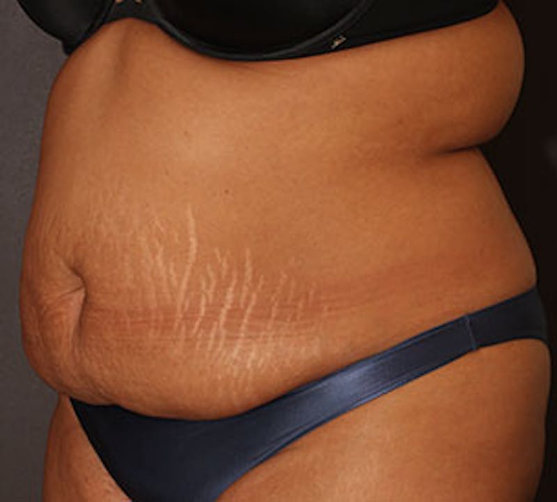 Abdominoplasty (Tummy Tuck) Before & After Gallery - Patient 117645901 - Image 3