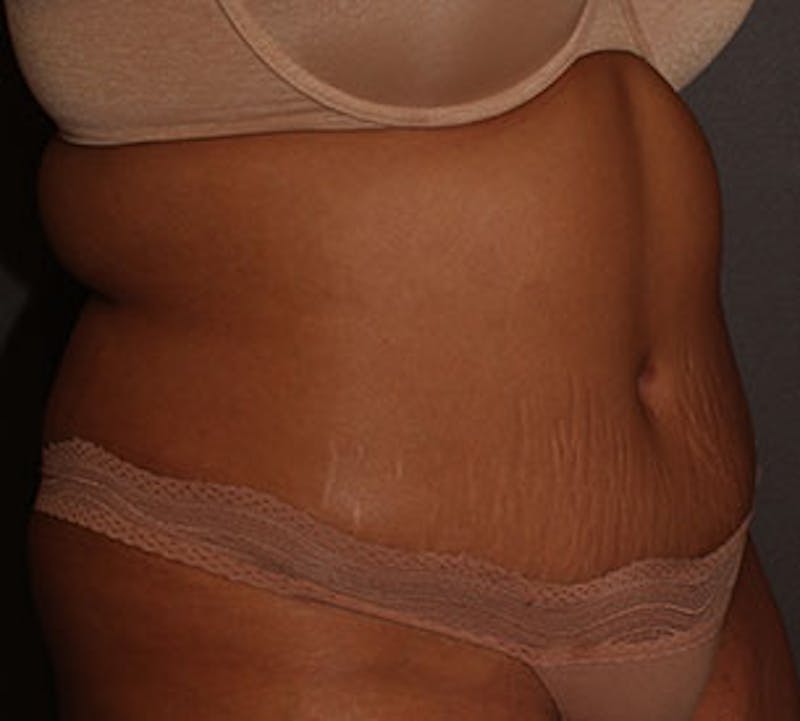 Abdominoplasty (Tummy Tuck) Before & After Gallery - Patient 117645901 - Image 6