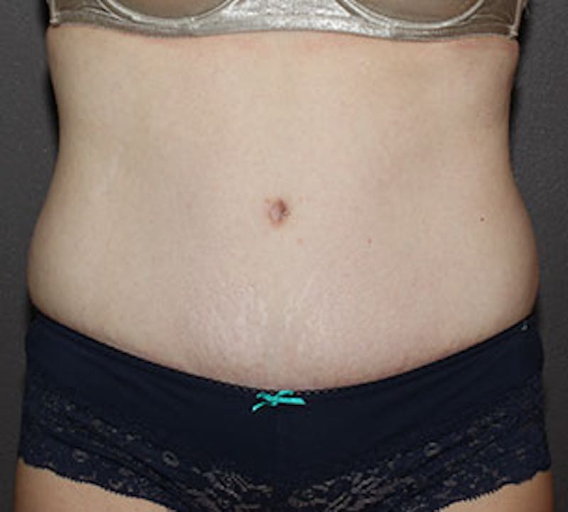 Abdominoplasty (Tummy Tuck) Before & After Gallery - Patient 117645902 - Image 2