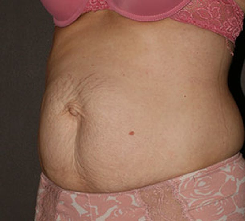 Abdominoplasty (Tummy Tuck) Before & After Gallery - Patient 117645902 - Image 3