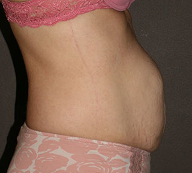 Abdominoplasty (Tummy Tuck) Before & After Gallery - Patient 117645902 - Image 9