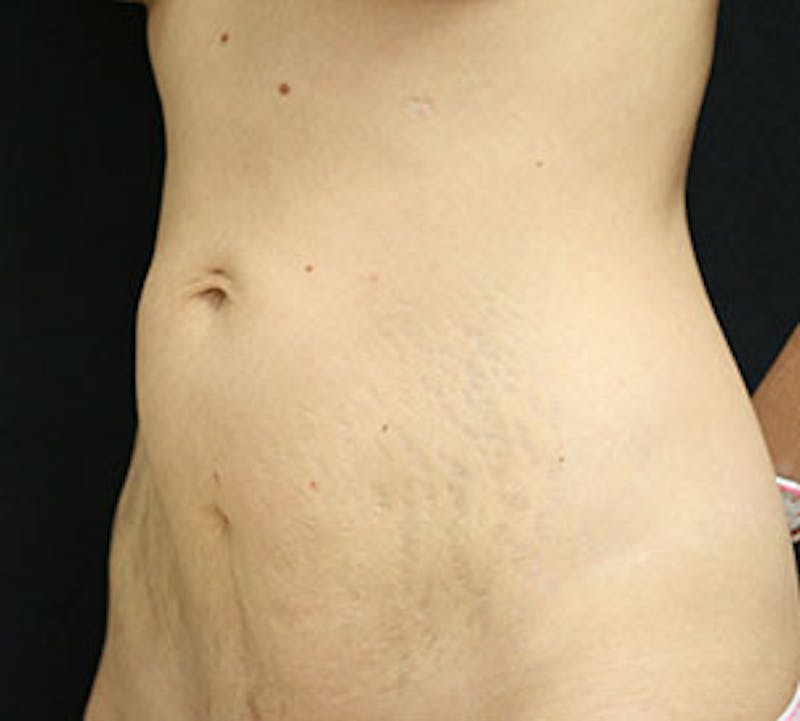 Abdominoplasty (Tummy Tuck) Before & After Gallery - Patient 117645903 - Image 5