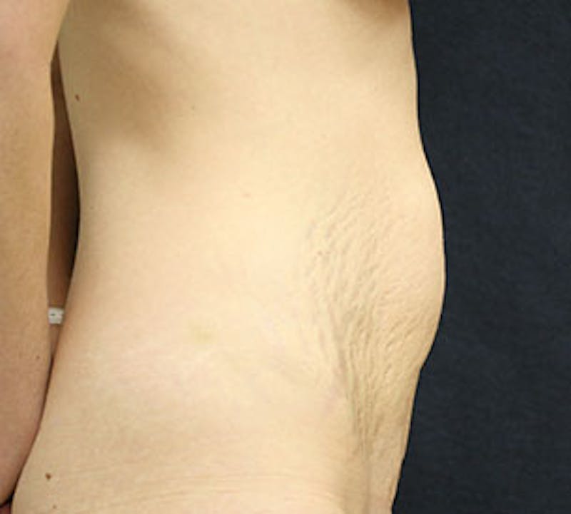 Abdominoplasty (Tummy Tuck) Before & After Gallery - Patient 117645903 - Image 7