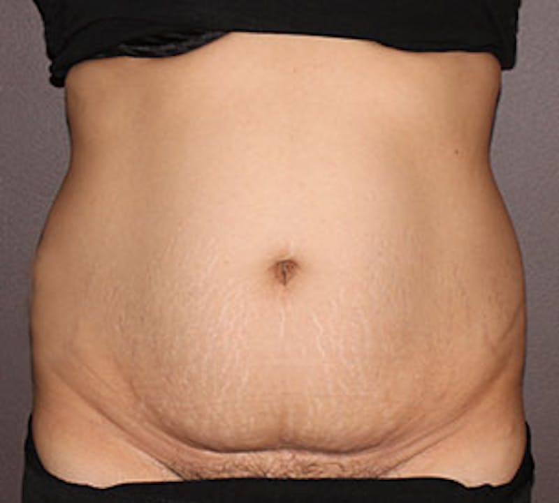 Abdominoplasty (Tummy Tuck) Before & After Gallery - Patient 117645904 - Image 1