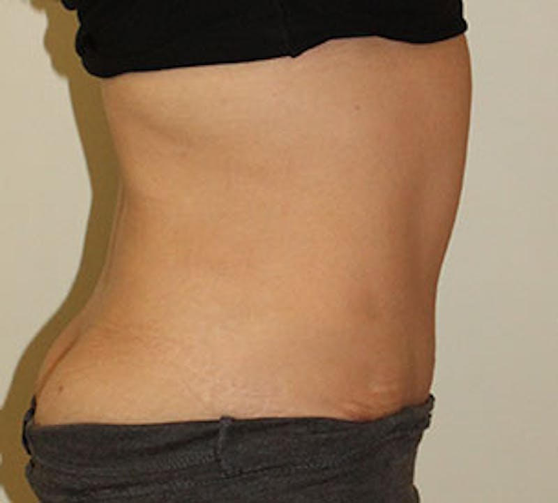 Abdominoplasty (Tummy Tuck) Before & After Gallery - Patient 117645904 - Image 8