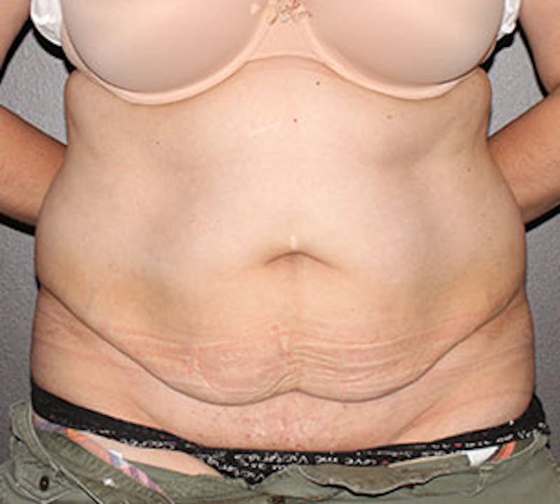 Abdominoplasty (Tummy Tuck) Before & After Gallery - Patient 117645905 - Image 1